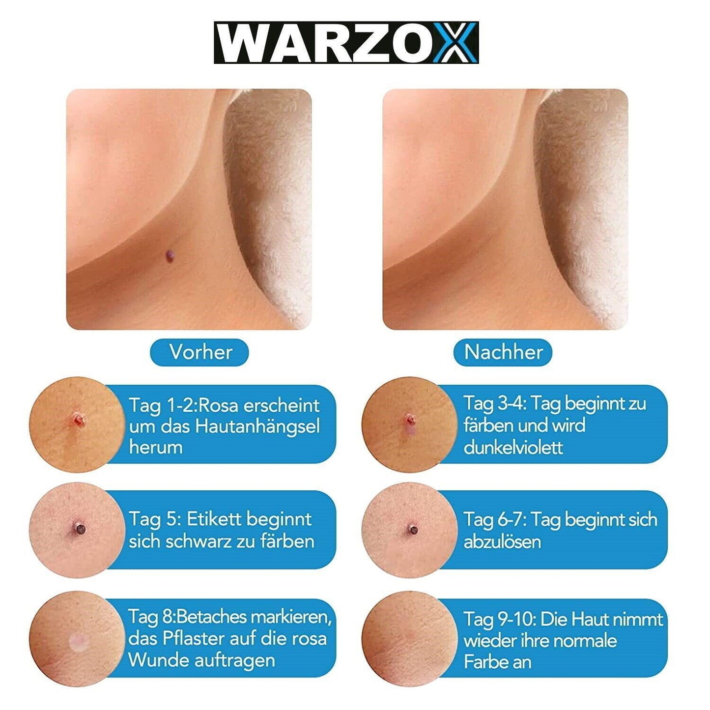 WARZOX Skin Tag Remover Kit Stielwarzen Set Fibrom Kosmetik Entferner 54tlg