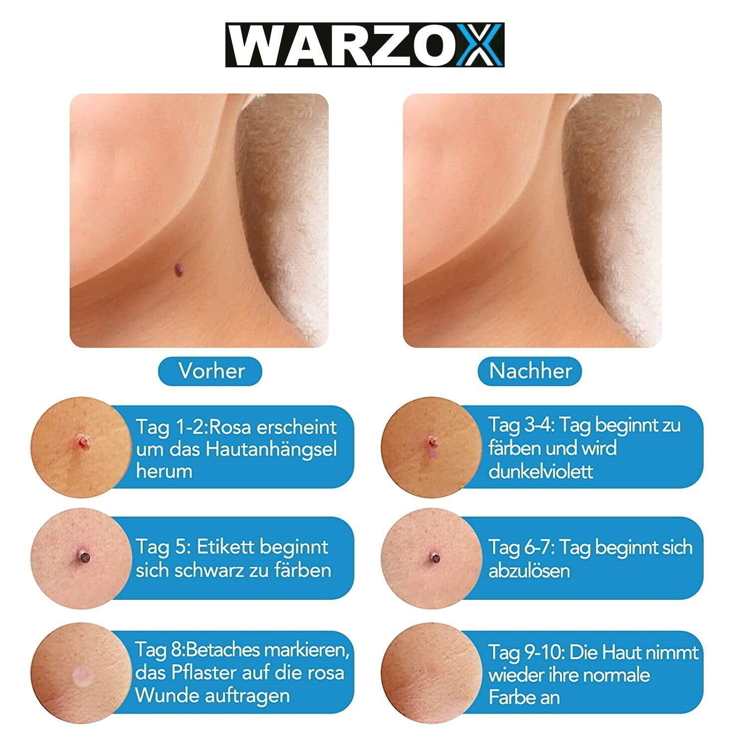 WARZOX Skin Tag Remover Kit Stielwarzen Set Fibrom Kosmetik Entferner 54tlg
