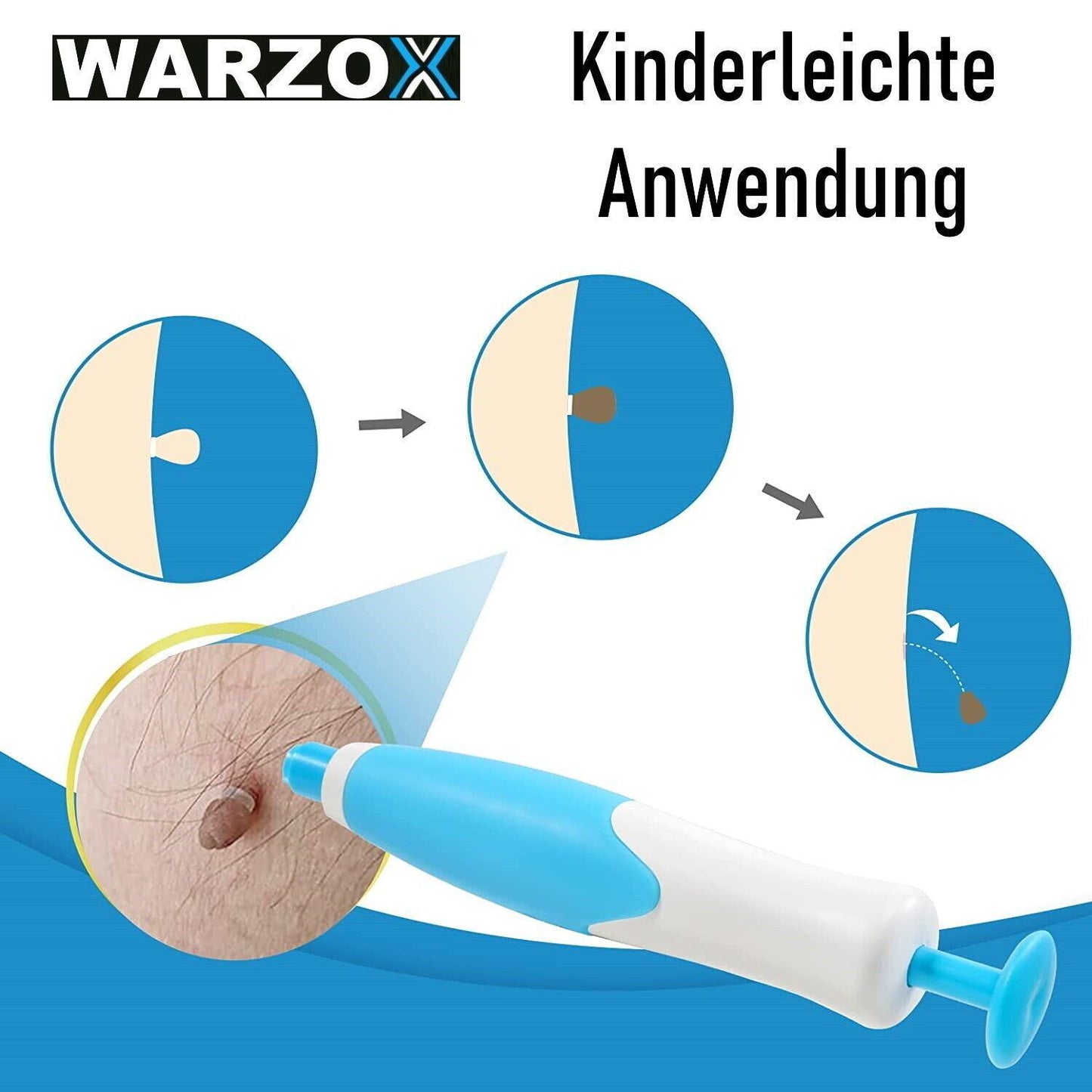 WARZOX Skin Tag Remover Kit Stielwarzen Set Fibrom Kosmetik Entferner 54tlg