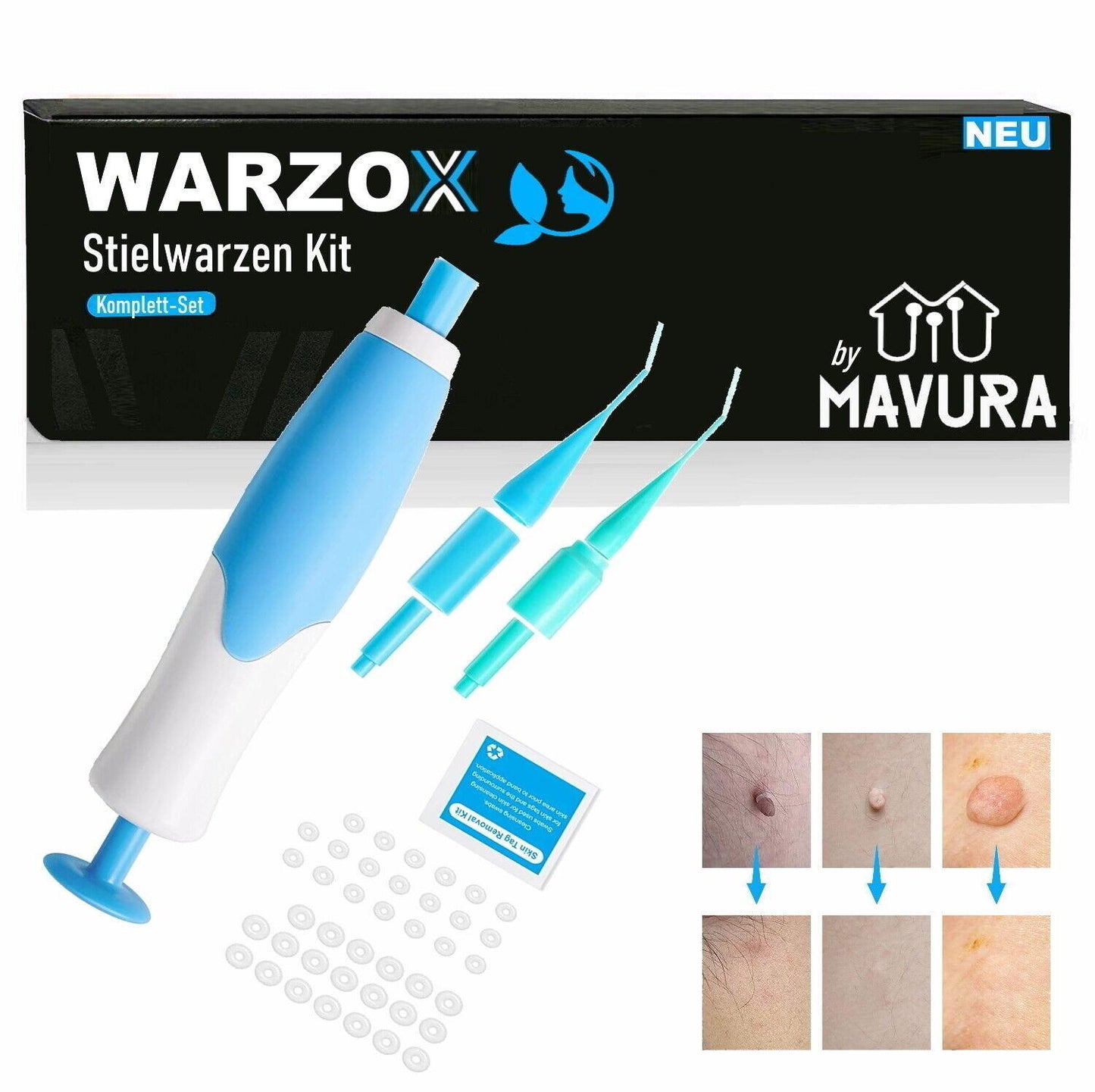 WARZOX Skin Tag Remover Kit Stielwarzen Set Fibrom Kosmetik Entferner 54tlg